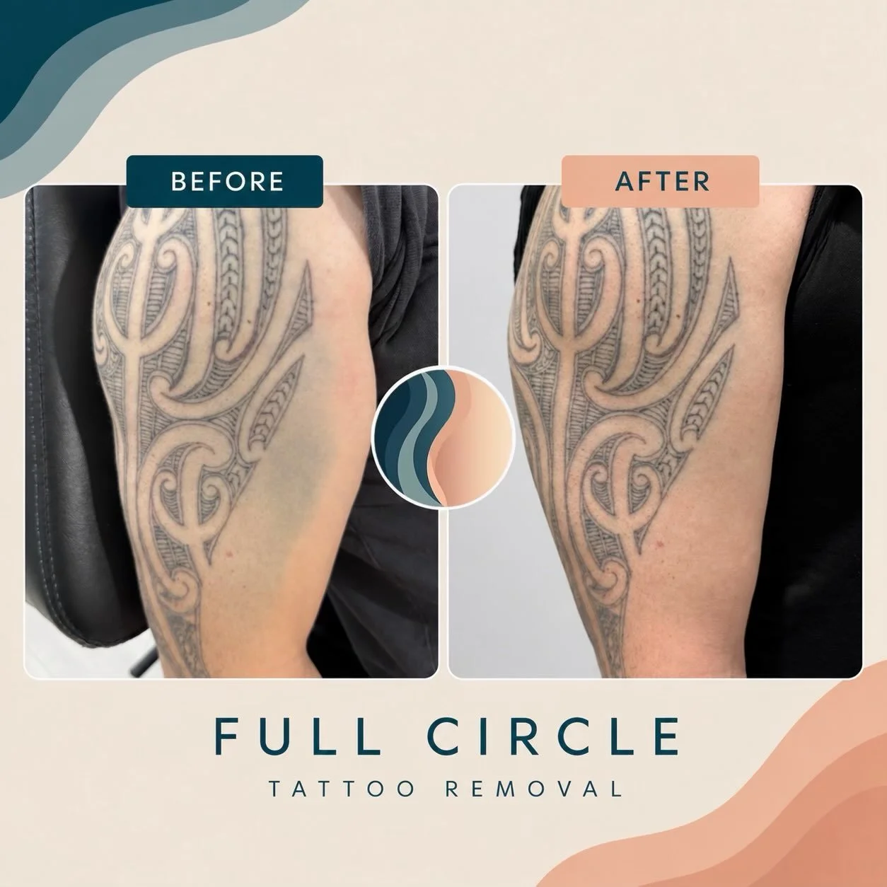 TATTOO BLOWOUT? LET&rsquo;S TALK 🗣️ 

Tattoo blowout happens when tattoo pigment spreads beyond the intended lines, creating a soft, blurred or shadow-like appearance around the tattoo.

At Full Circle Tattoo Removal, we can use targeted laser treat