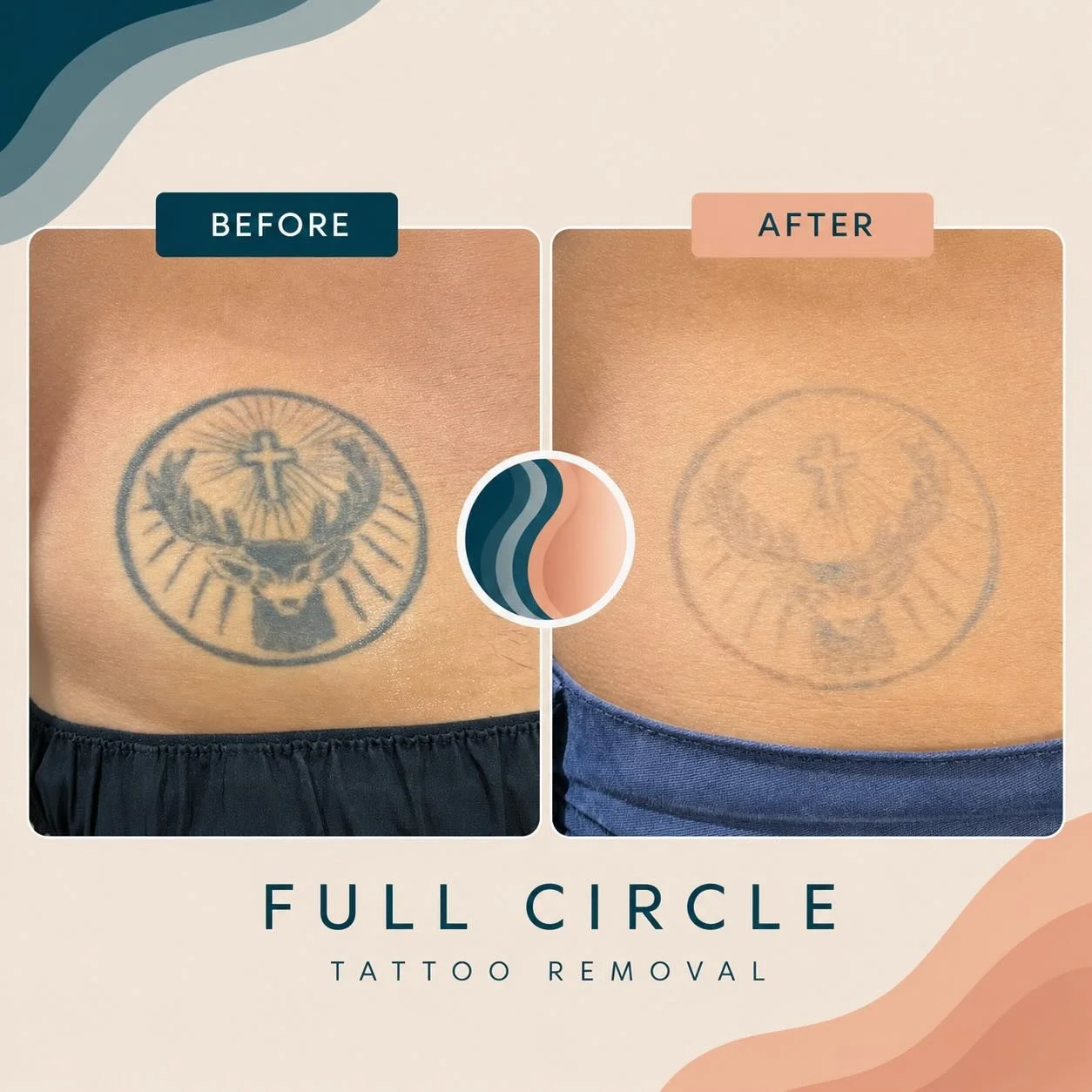 Only 3 sessions in 👏

Tattoo removal is a process, and we always set realistic expectations. While many tattoos require 5&ndash;10+ sessions for complete removal, some can show incredible fading much sooner.

This client has achieved this impressive