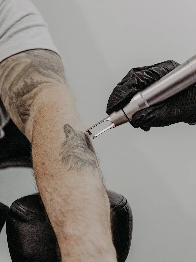 A person receiving a laser removal session on their arm from a laser operator using a Super Pico laser machine. The person's arm has tattoos, and the artist is wearing black gloves.