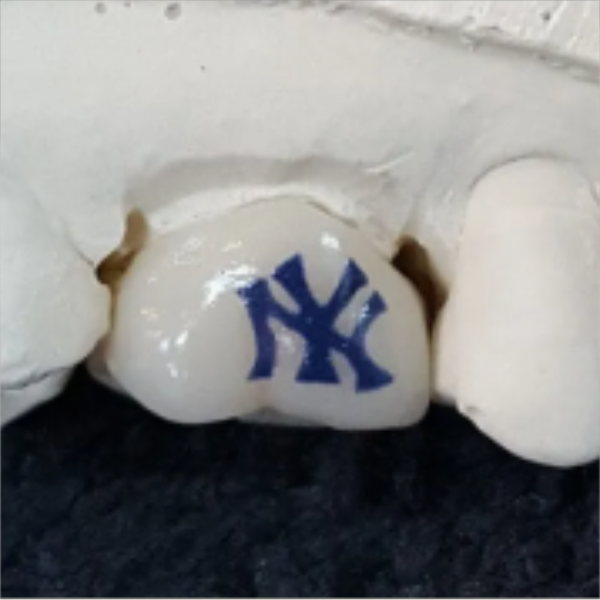 A dental prosthetic tooth with a New York Yankees logo painted on it.