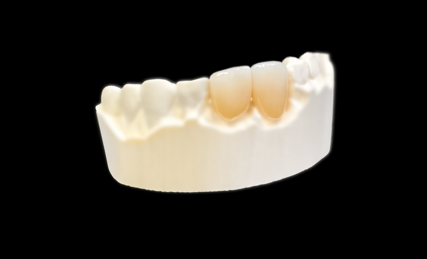 PDA_Anterior_Teeth_Ceramics_Translucency.png