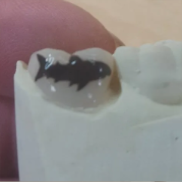 A close-up of a tooth with black and white dental treatment or decoration, possibly a temporary sticker or dental marker.