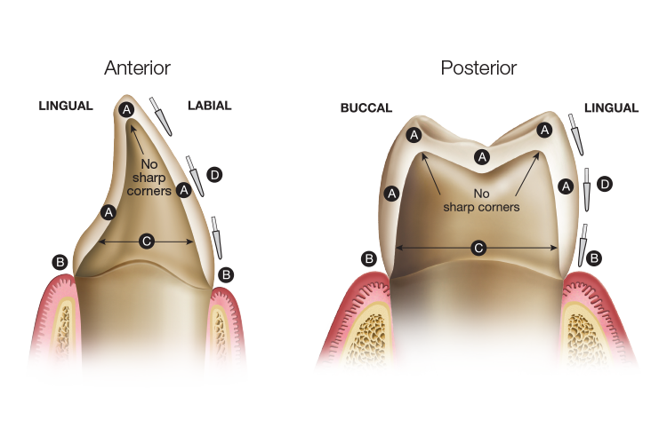 Diagram comparing healthy tooth with no sharp edges to a damaged tooth with sharp edges, showing differences in enamel and gum structure.