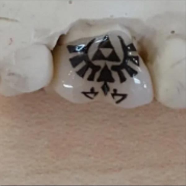 A dental crown with a black Triforce symbol from the Legend of Zelda, placed over a person's molar in their mouth.