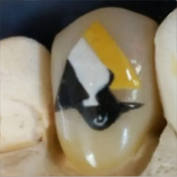 A dental crown with a black and white penguin face painted on it, featuring a yellow beak.