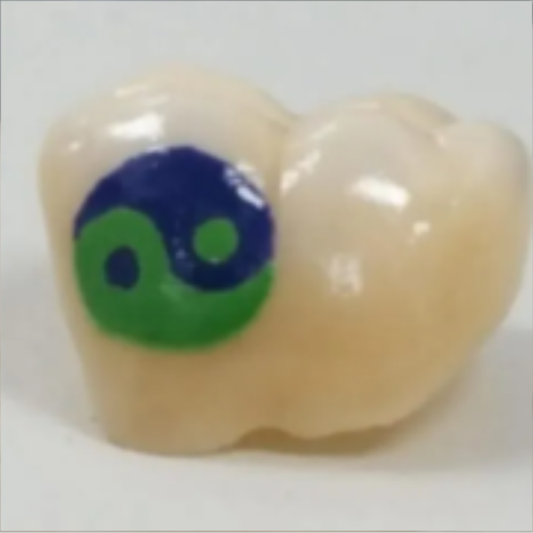 Close-up of a tooth with a green and blue smiley face painted on it.