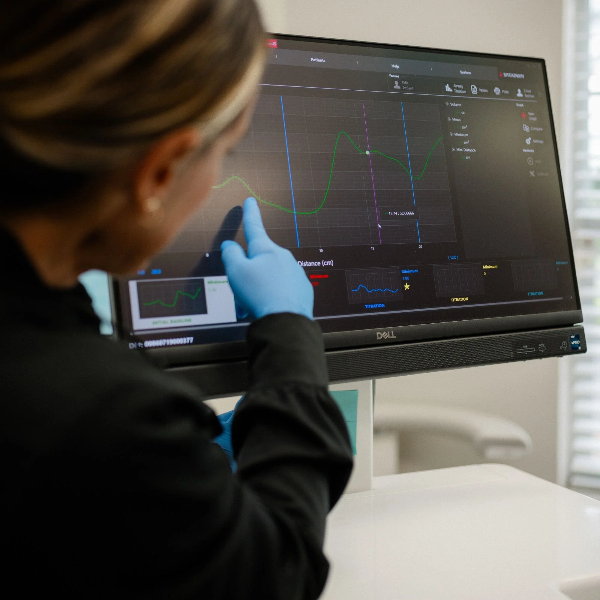 A person wearing blue gloves is pointing at a medical graph on a computer screen. The graph shows green and purple lines with data points and various labels related to patient measurements.