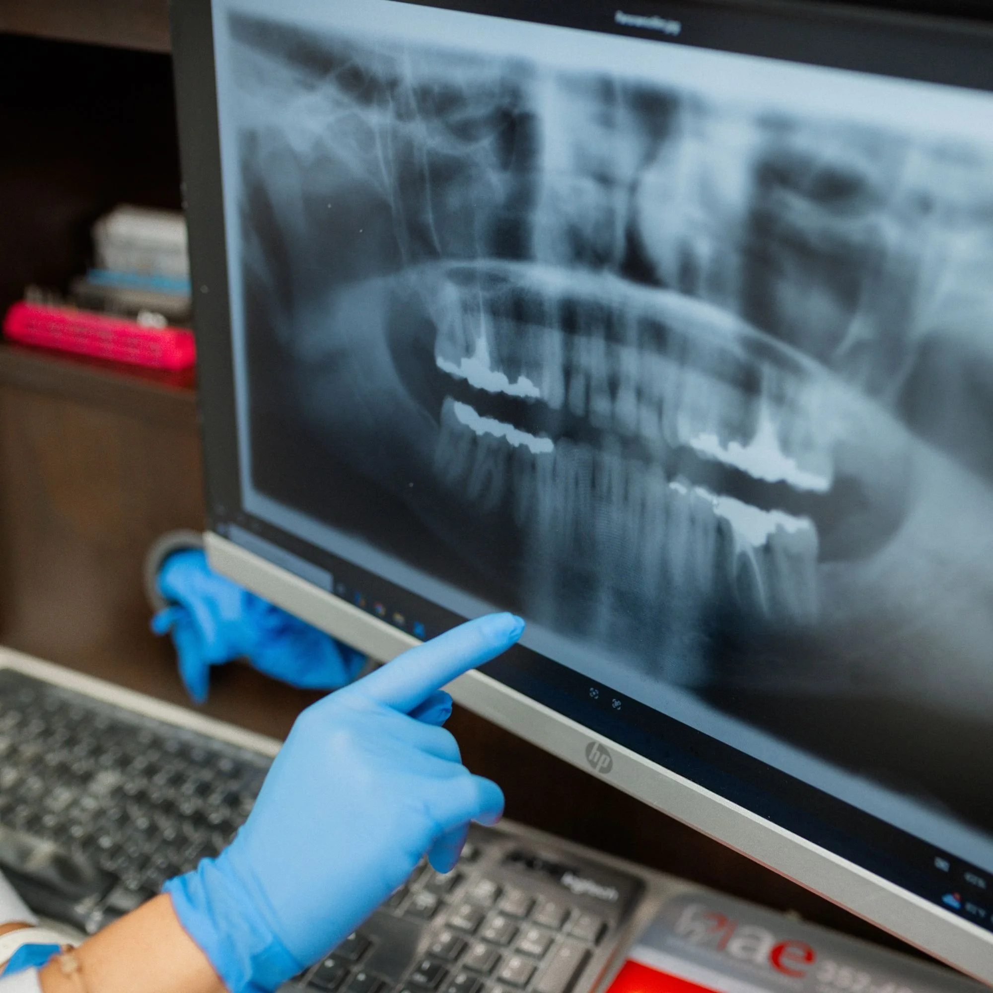 A person wearing blue gloves touching a laptop monitor displaying an X-ray image of a skull.