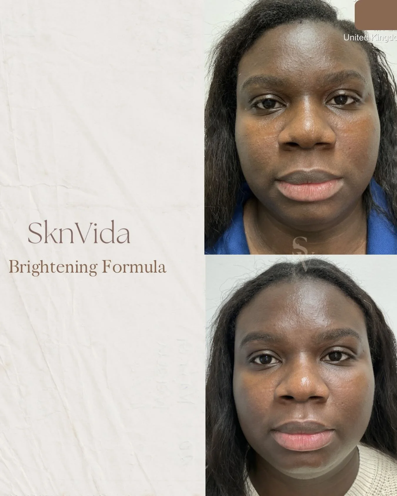 Chemical Peel Results ✨

This transformation shows the progress achieved after one brightening formula peel at SknVida Clinic 

While many clients see an immediate &lsquo;glow&rsquo; and improved clarity, skin health is a journey. 
Some may require a