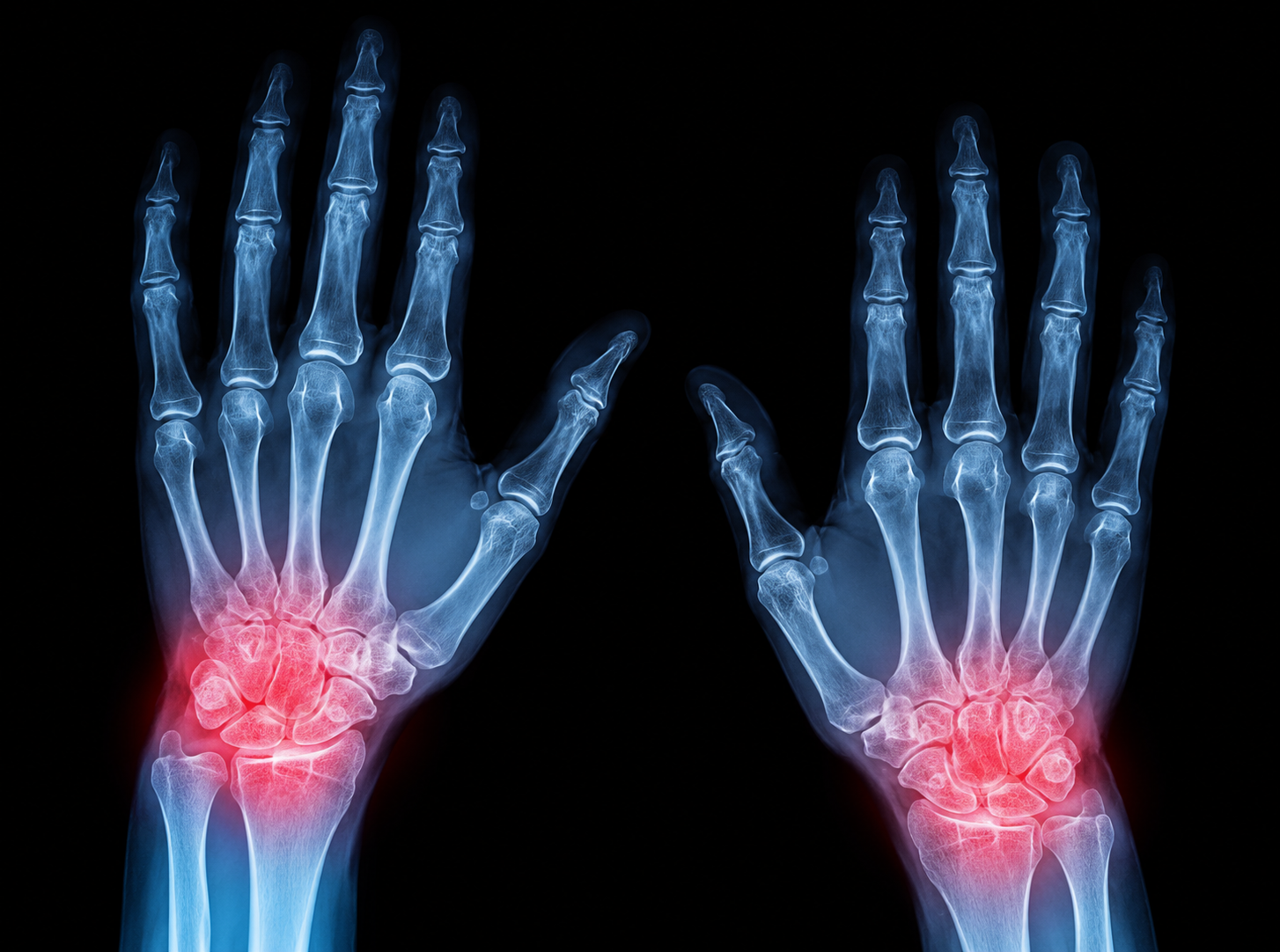 Wrist Arthritis
