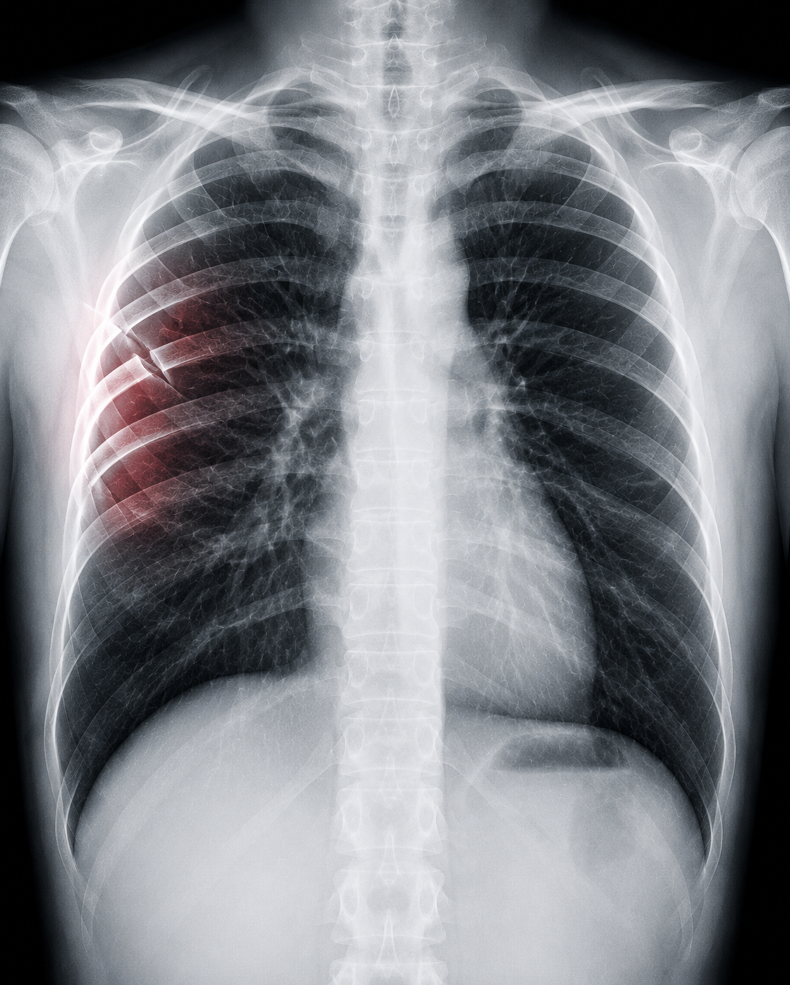 Fracture Care