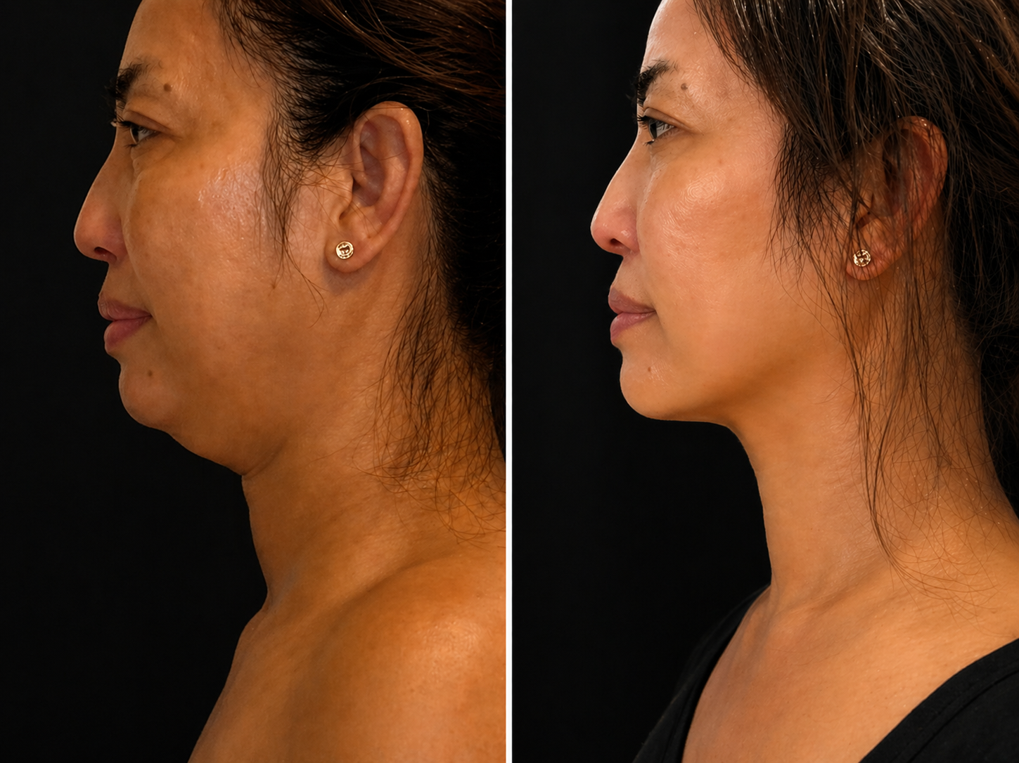 KYBELLA