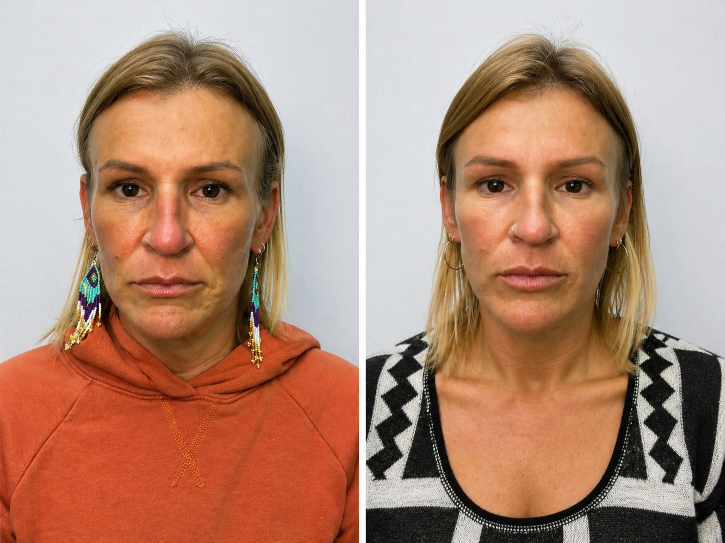 ANTI WRINKLE