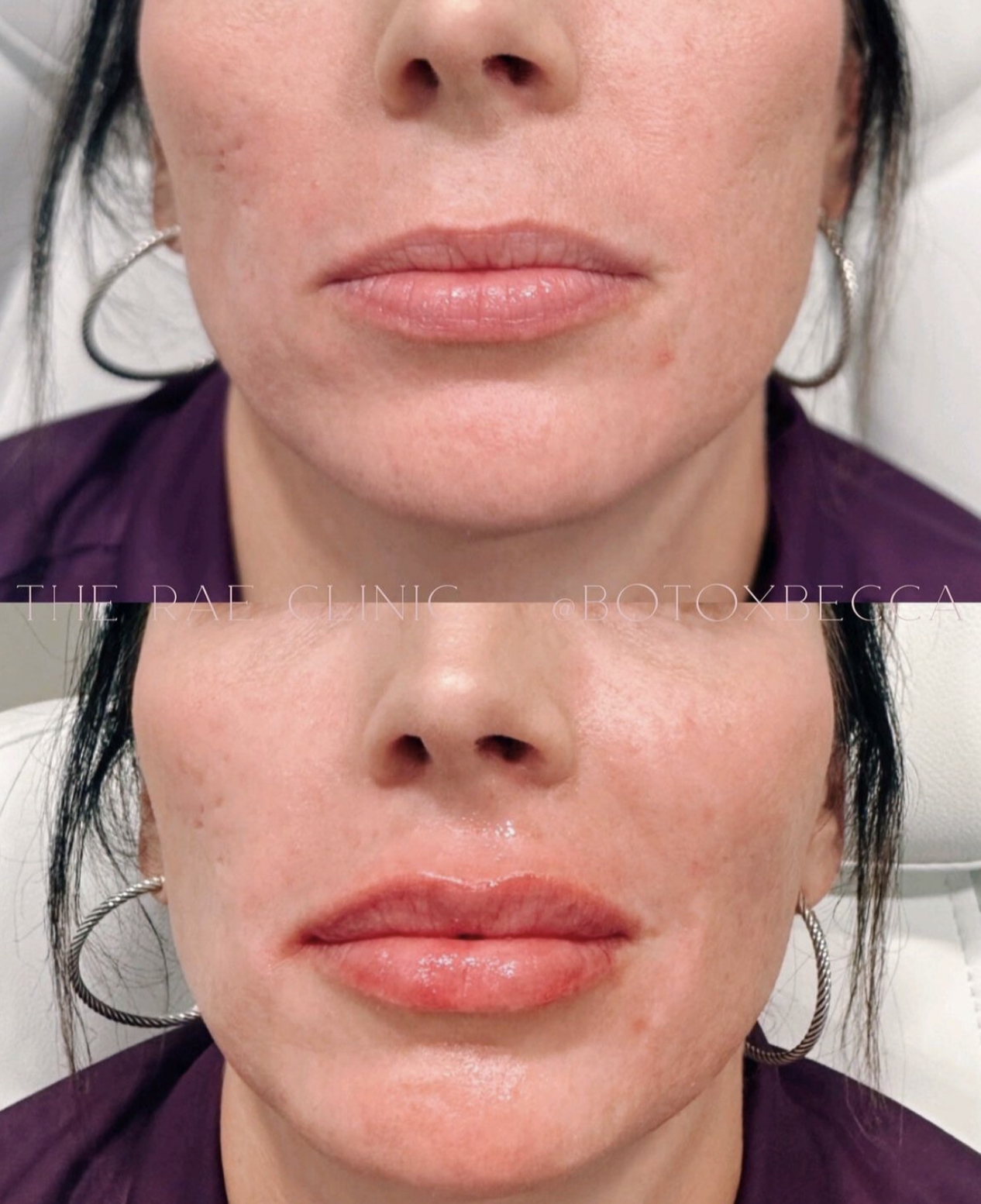 Lip filler before and after fuller results | Rebecca Williford, DNP-BC | The Rae Clinic | Evans, Augusta, GA