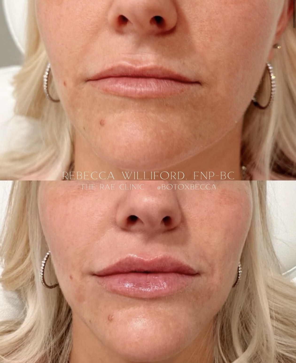 Lip filler before and after natural & fuller results | Rebecca Williford, DNP-BC | The Rae Clinic | Evans, Augusta, GA