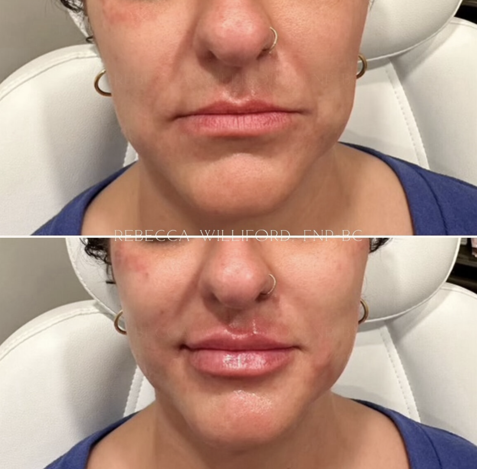 Lip filler before and after fuller results | Rebecca Williford, DNP-BC | The Rae Clinic | Evans, Augusta, GA