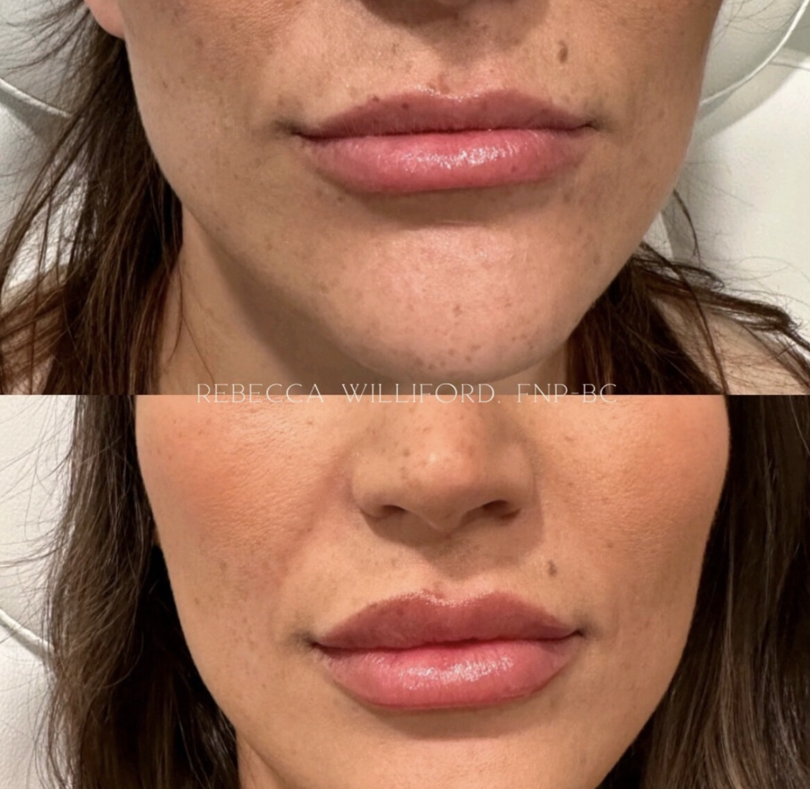 Lip filler before and after natural & balanced results | Rebecca Williford, DNP-BC | The Rae Clinic | Evans, Augusta, GA