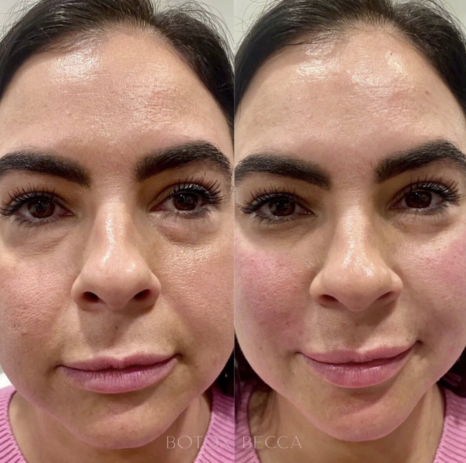 Facial balancing before and after full featuring cheeks, chin, and temples | Rebecca Williford, DNP-BC | The Rae Clinic | Evans, Augusta, GA