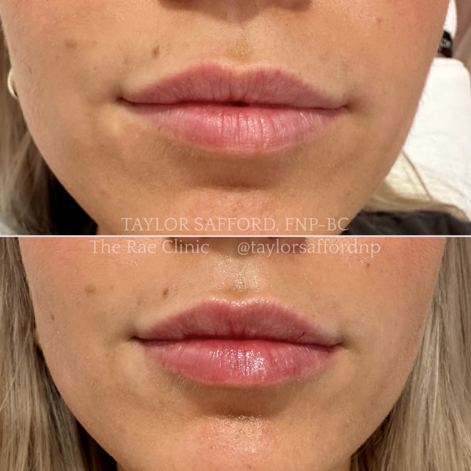 Lip filler before and after natural and fuller results | Taylor Safford, NP | The Rae Clinic inside Rosewater Spa | Evans, Augusta, GA