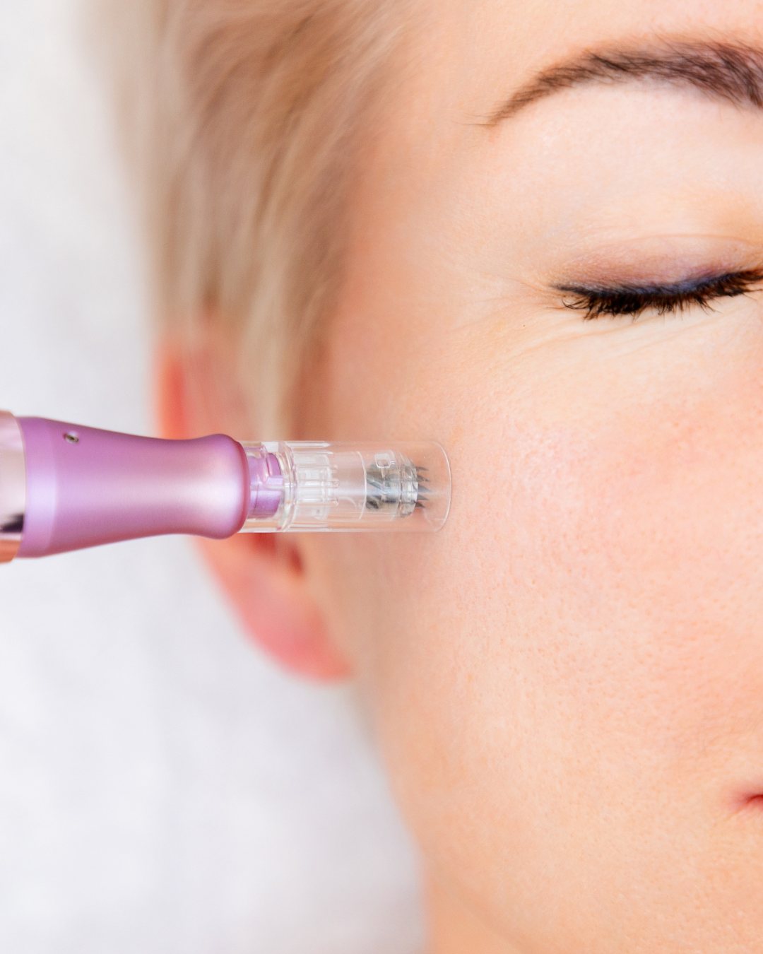 Microneedling device being used on a patient face | The Rae Clinic in Evans, Augusta, GA