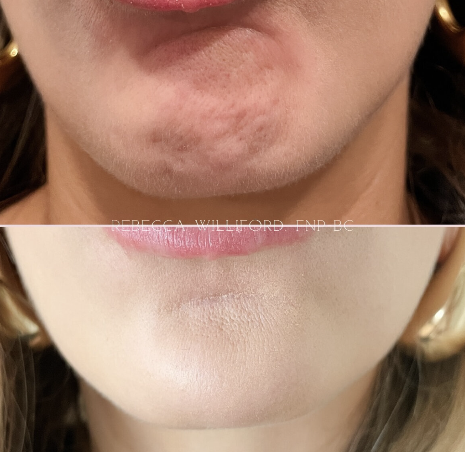 Neurotoxin before and after in chin for "orange peel" | Rebecca Williford, DNP-BC | The Rae Clinic | Evans, Augusta, GA