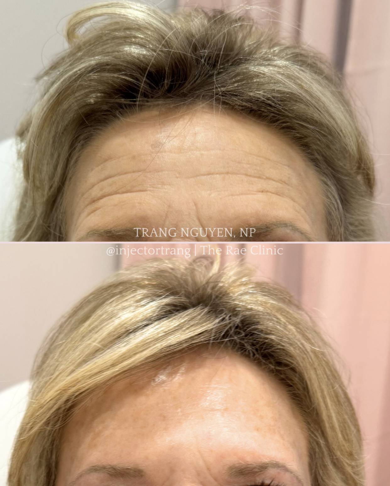 Neurotoxin before and after forehead lines | Trang Nguyen, NP | The Rae Clinic | Evans, Augusta, GA