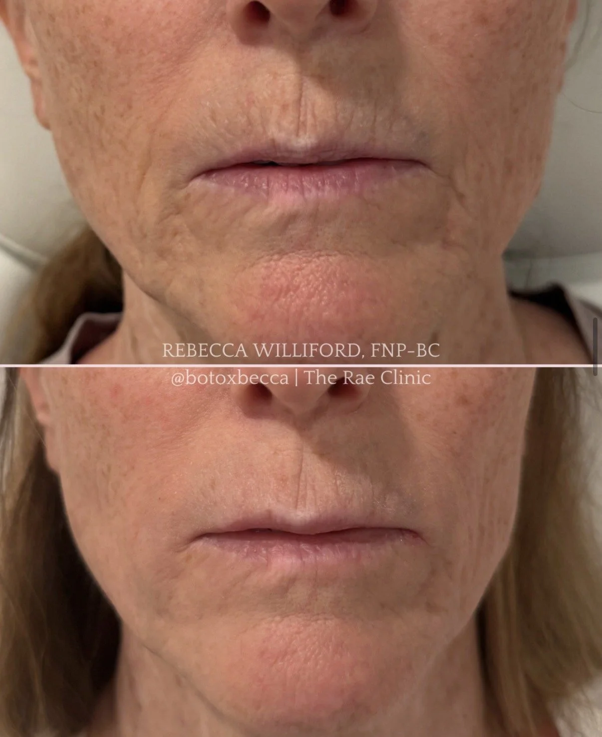 Dermal filler before and after lower face rejuvenation | Rebecca Williford, DNP-BC | The Rae Clinic | Evans, Augusta, GA