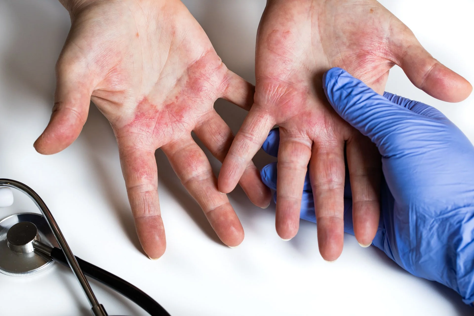 UVB for eczema
