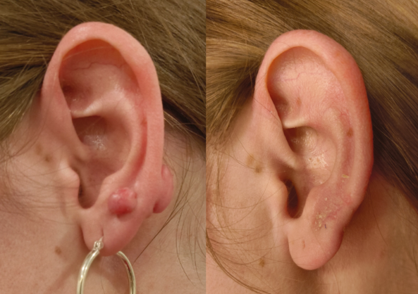 Keloid Before & After