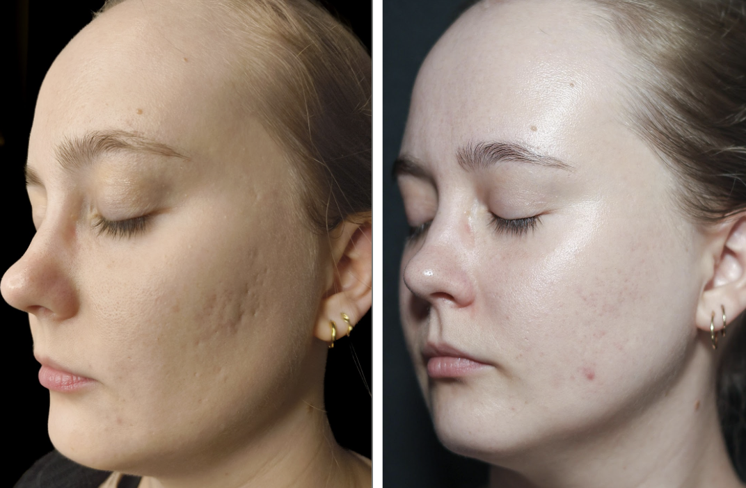 Acne scar before and after treatments
