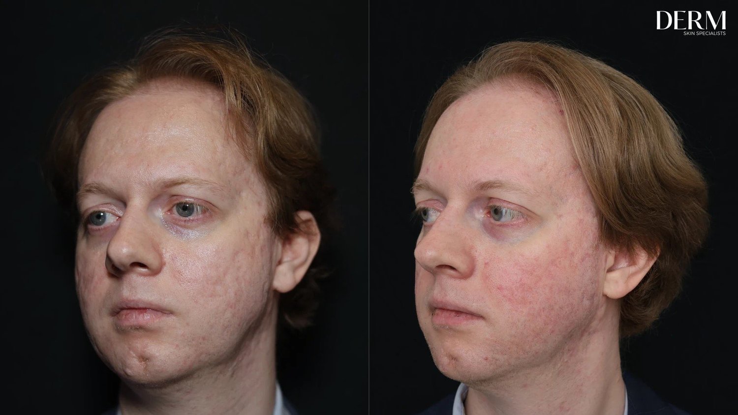 Acne scars on the cheek and temple before, and 10 weeks after punch excision, subcision and fully ablative CO2 laser resurfacing at DERM Skin Specialists, Mount Gravatt