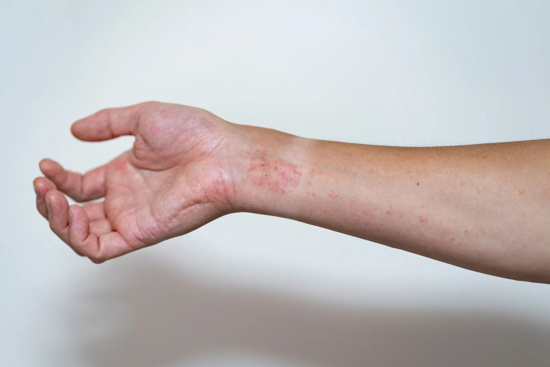 topical anti-inflammatory for eczema.jpg