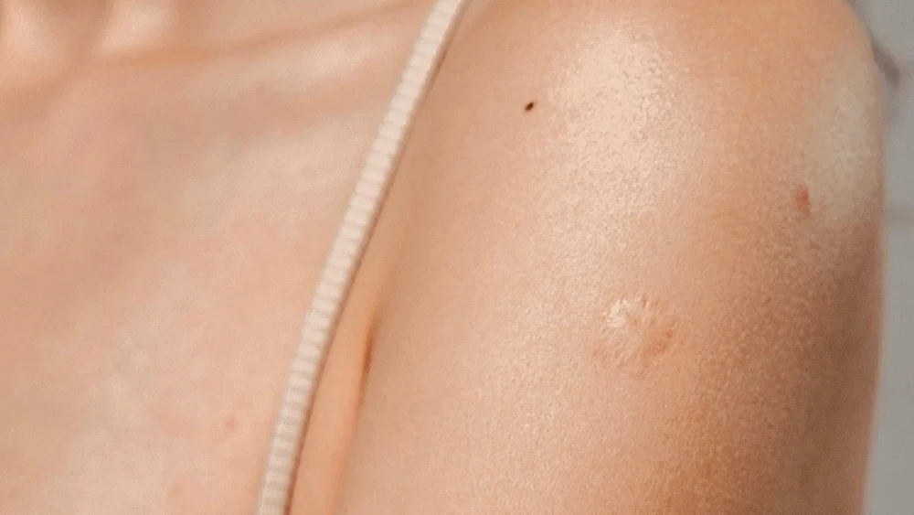 Small raised scars on the shoulder, a common reason for scar treatment in Brisbane