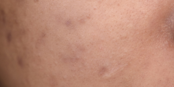 Flat red and brown marks left on the skin after acne