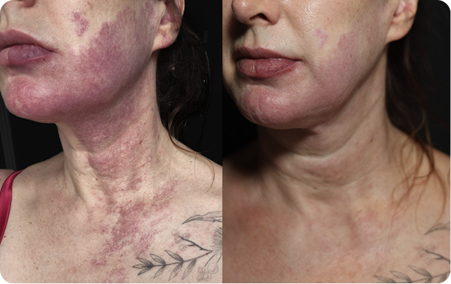 rosacea wine stain derma v