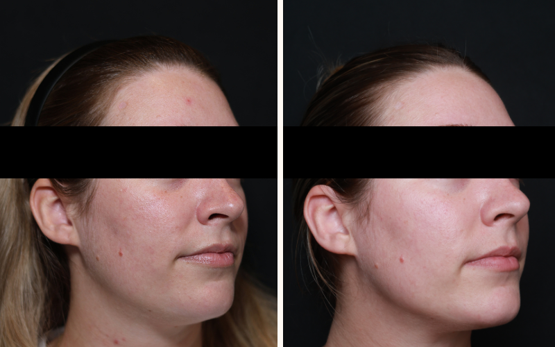 Skin tone and texture before and 4 months after one session of LaseMD Ultra at DERM Skin Specialists, Brisbane