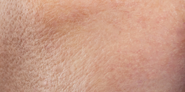 LaseMD for dull skin tone