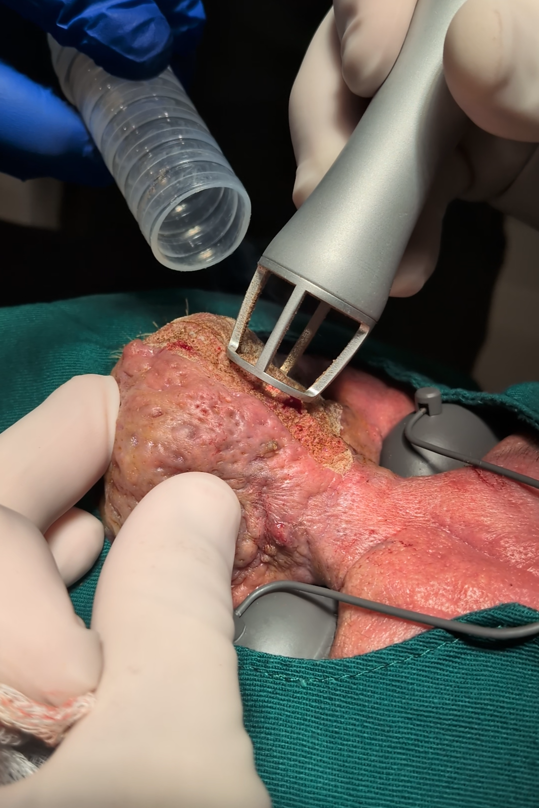 Rhinophyma medical procedures in South Brisbane