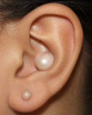 Keloid scar management at Derm Skin Specialists dermatology clinic in Brisbane