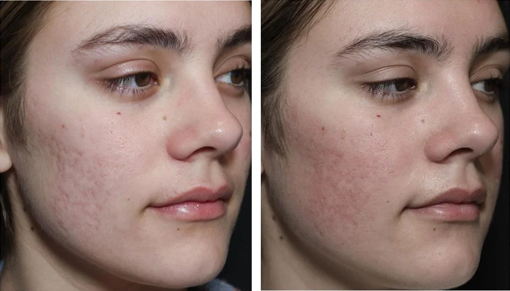 Rolling acne scar before and after