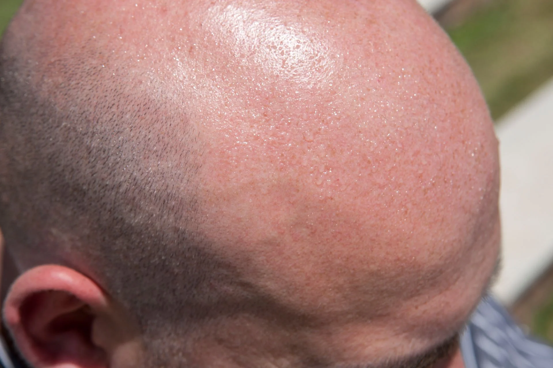 Sun damage