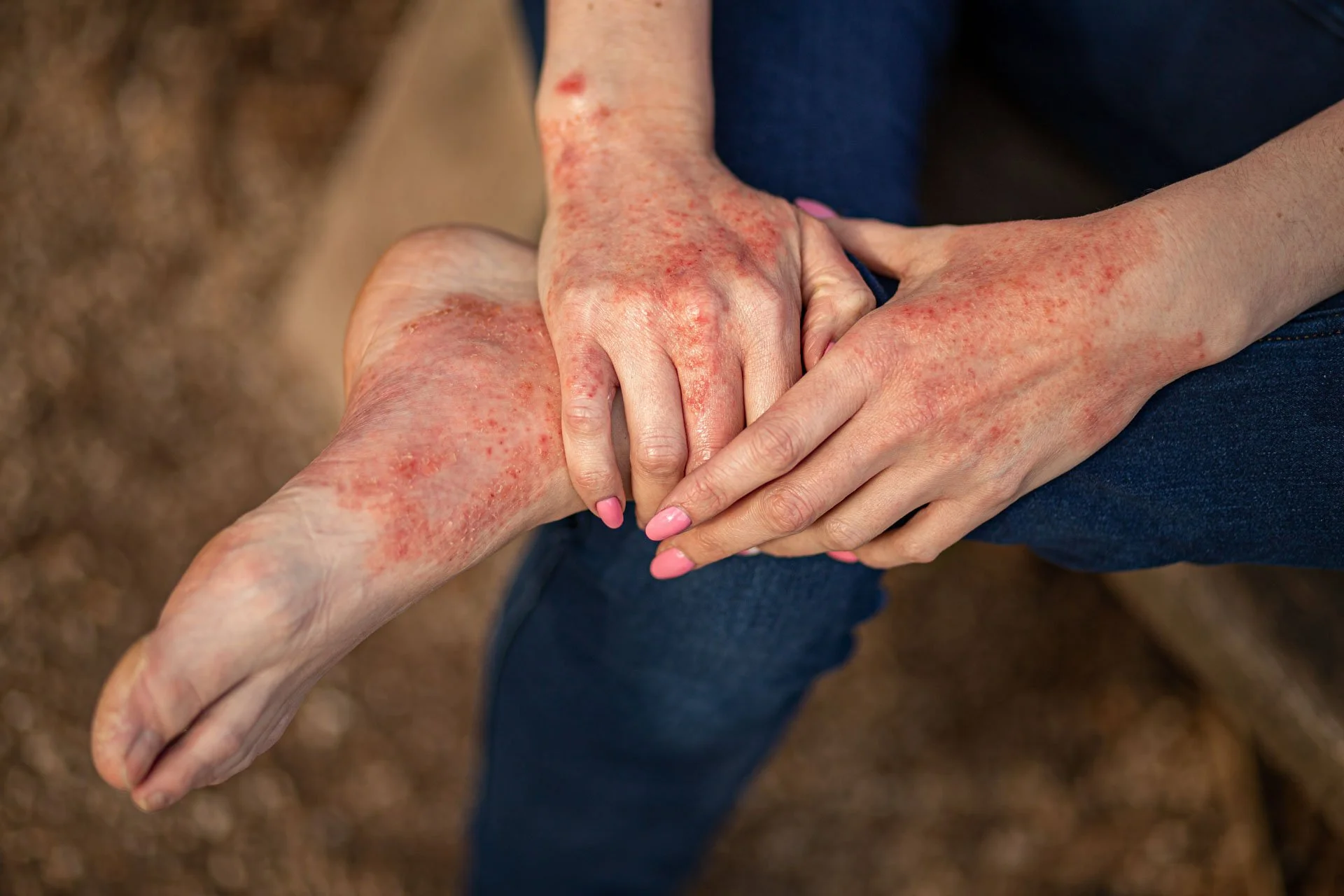 infectious eczema