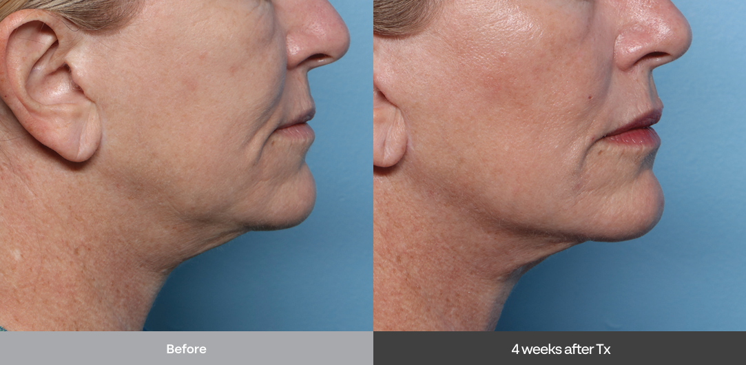 xerf brisbane skin tightening and rejuvenation