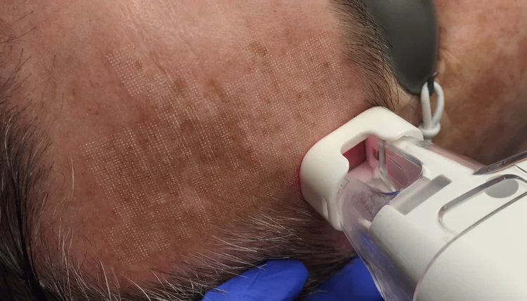 LaseMD ULTRA laser handpiece on a patient's cheek at DERM Skin Specialists