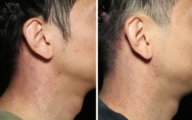 Rosacea port wint stain treatment brisbane