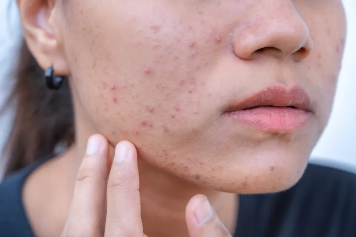 how to treat acne scars