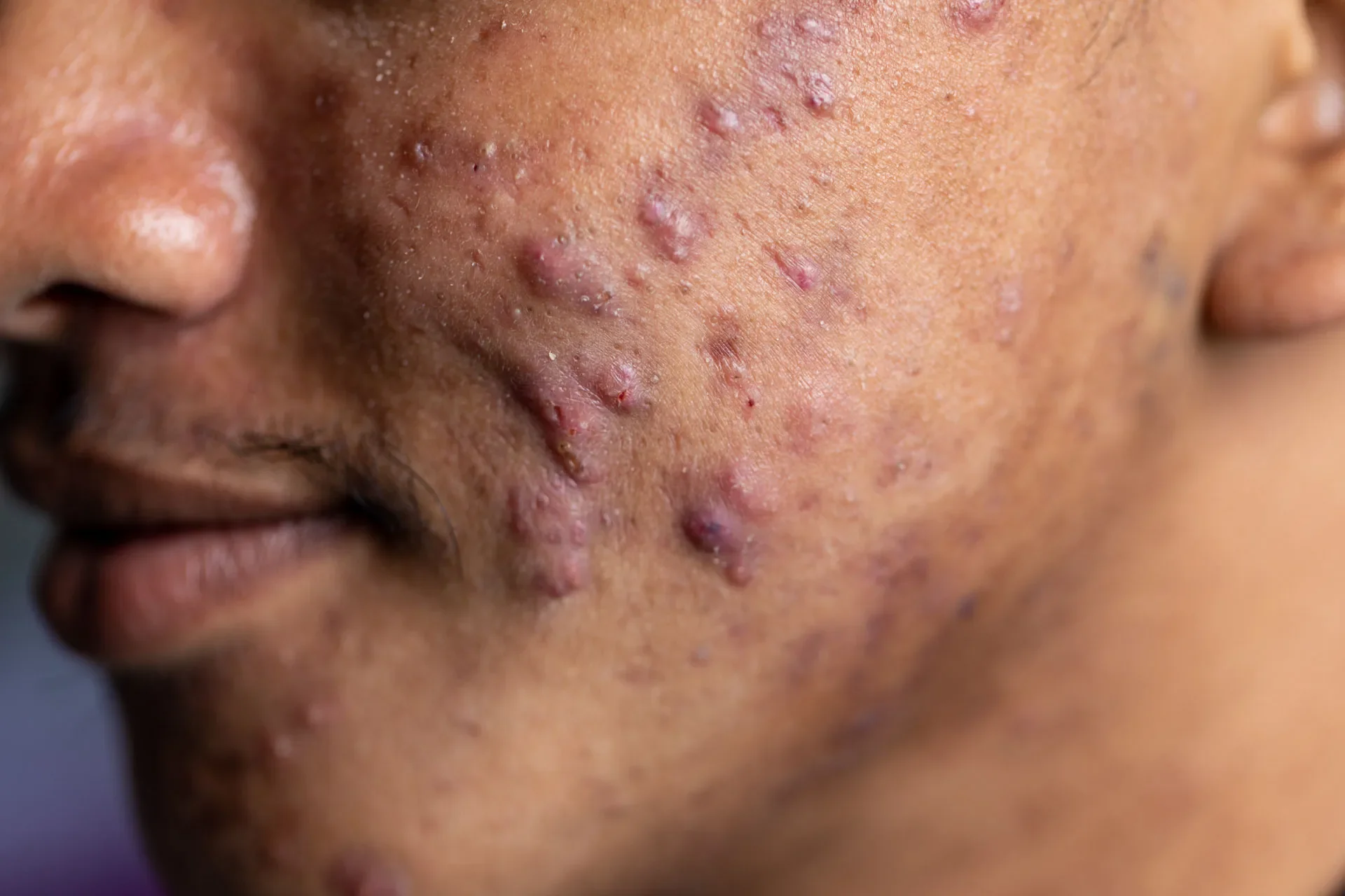 Hypertrophic acne scars can be managed through both device and medical intervention. At Derm Skin Specialists, we can help you manage your skin concerns.
