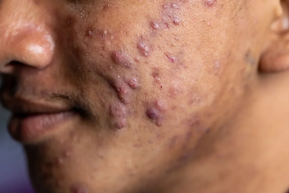 Raised hypertrophic acne scars on the skin