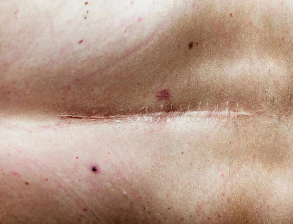 Healed linear surgical scar on the skin, the kind of scar treated with scar revision in Brisbane