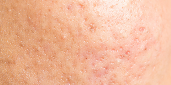 Close-up of pitted acne scars, which RedTouch PRO can help when mild